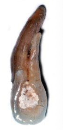 <p>Lingual developmental or palato-radicular groove</p>