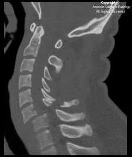 <ul><li><p>Flaccid paralysis of the skeletal muscles below the level of the injury</p></li><li><p>Loss of all sensation below the level of the injury; pain at the site of injury possible</p></li><li><p>Respiratory distress</p></li><li><p>Bradycardia</p></li><li><p>Loss of body temperature control</p></li><li><p>Absence of somatic and visceral sensations below the site of injury</p></li><li><p>Unstable lowered blood pressure</p></li><li><p>Loss of ability to perspire below injury site</p></li><li><p>Bowel and bladder incontinence</p></li></ul><p></p>