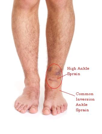 <p>High Ankle Sprain </p>