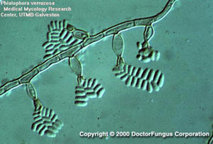 <p>chromoblastomycosis</p>