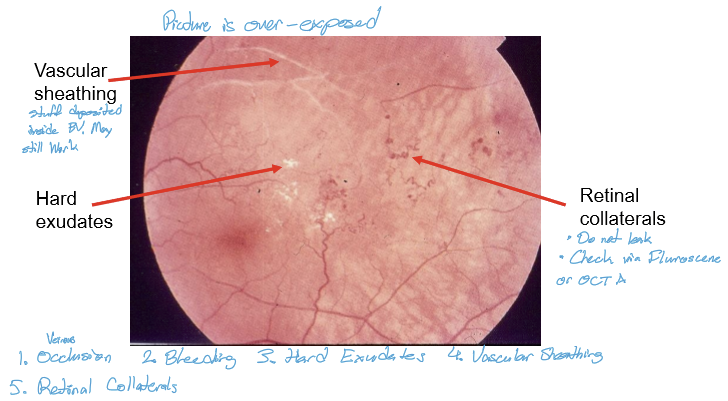 <p>Blood vessels that develop within existing besselslk, usually near areas of nonperfusion. It can be capillary-to-capillary, vein-to-vein, artery-to-artery, artery-to-vein.</p>