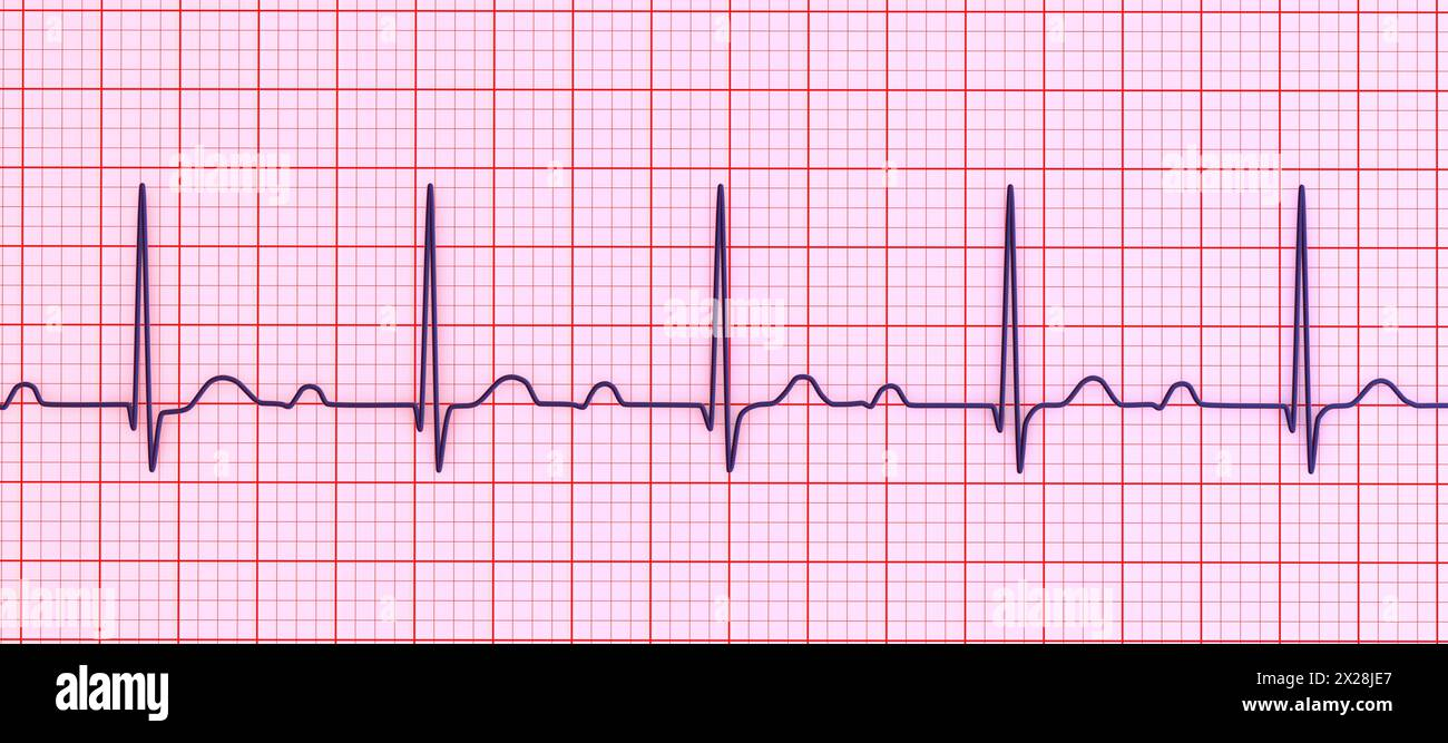 <p>Rate: depends on underlying rhythm</p><p>Regularity: regular </p><p>PRI is >0.20 seconds </p>