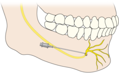 <p>part of the inferior alveolar nerve that exits the mental foramen to bring sensory information from the chin</p>