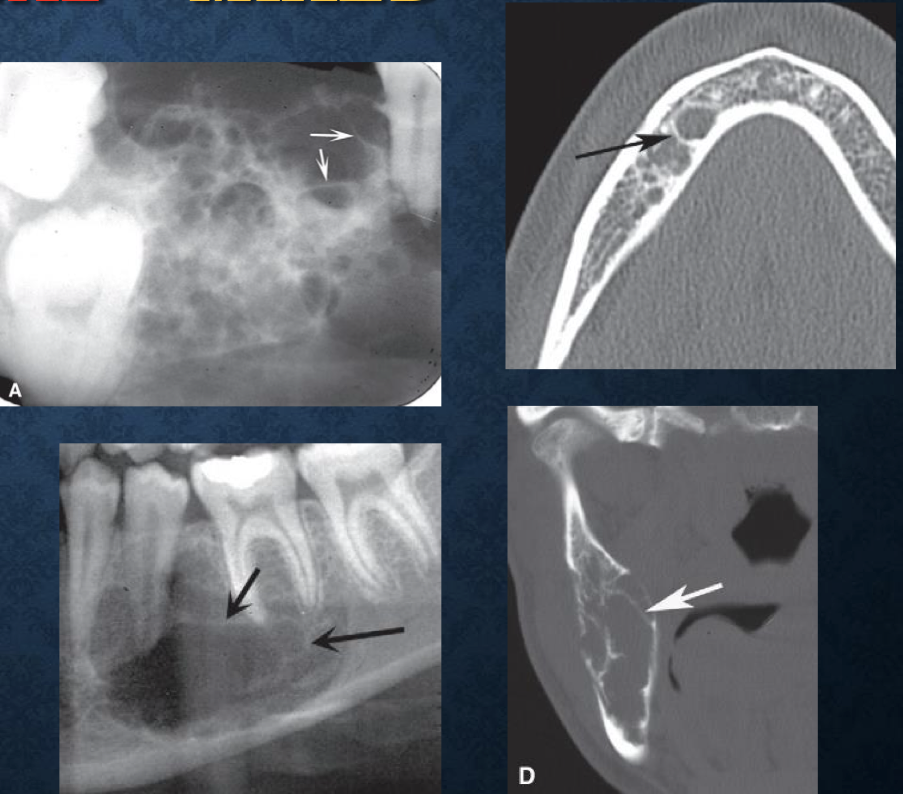 <p>strands of bone, can divide lesion into compartments- multilocular</p><p>can be curved or straight, coarse or fine</p>