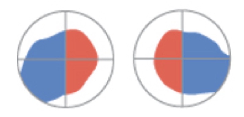<p>bitemporal hemianopia </p>