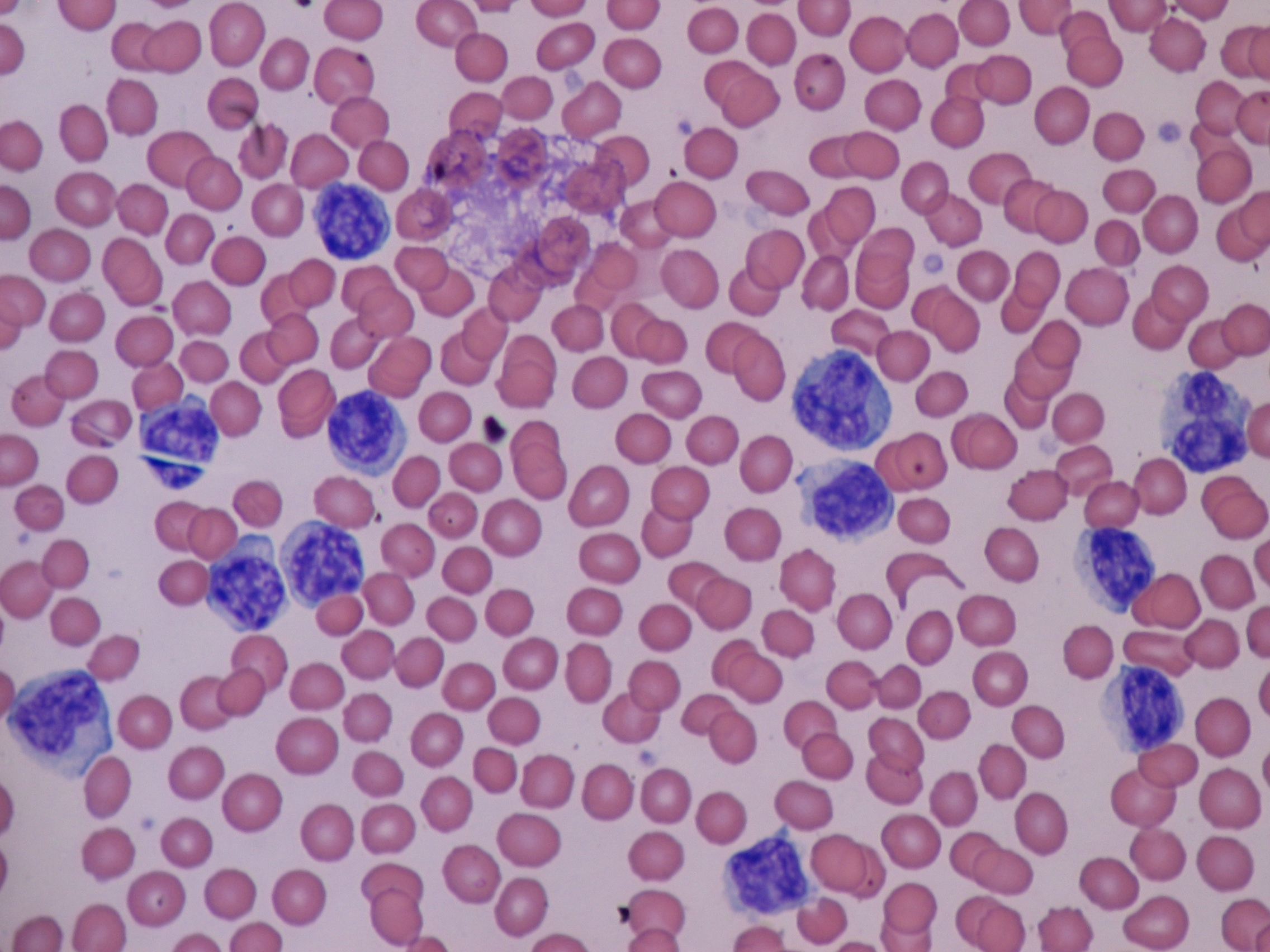 <p>LYMPHOCYTOSIS</p>