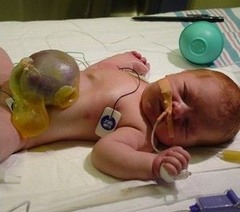 <p>extrusion of abd content through abd fold, covered by peritonium, usually midline. Diagnosed clinically.</p>