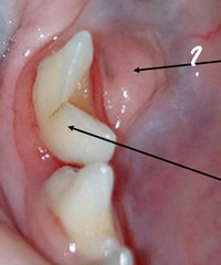 <p>You are in a cat and extracting the 1st mandibular molar. You see this swelling. Is it pathologic? What is it?</p>