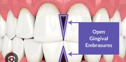<p><strong>Embrasure</strong></p>
