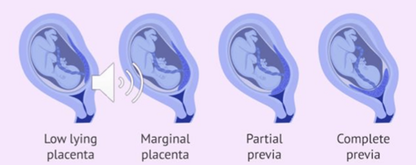 <p>Placenta Previa occurs when the placenta covers part or all of the cervix, leading to painless bright bleeding.</p>