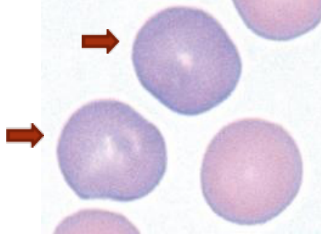 <p>term used for Polychromatophilic erythrocyte when bluish tint is <strong>scattered/spread</strong> in the cytoplasm</p><p></p>