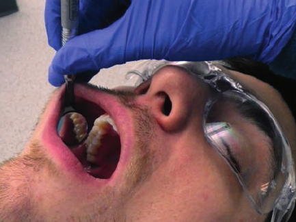 <ul><li><p>Sit 1 to 2 o’ clock position</p></li><li><p>Slide mirror head between dental arches</p></li><li><p>Rest ring and pinkie on right side of face</p></li><li><p>Use mirror to retract buccal mucosa away</p></li><li><p>Swivel mirror head until you can easily view the distal surfaces</p></li><li><p>Swivel mirror head until you can view facial and mesial surfaces in the reflecting surfaces </p></li></ul><p></p>