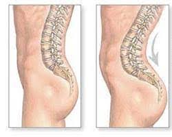 <p>Alteración postural de la curvatura natural hacia adentro de la columna vertebral.</p>