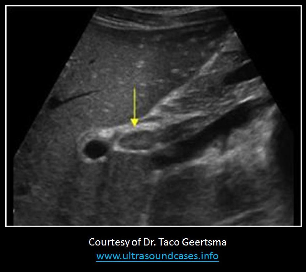 <p>The image is the first sagittal image of an abdominal ultrasound exam your performing. What should you be sure to do during the rest of the exam for this patient?</p>