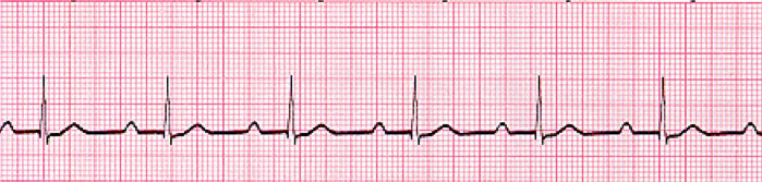 <p>What pathology is shown on the ECG? What are the defining characteristics?</p>