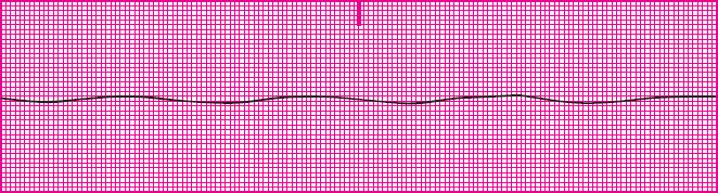 <p>Which rhythm is this?</p>
