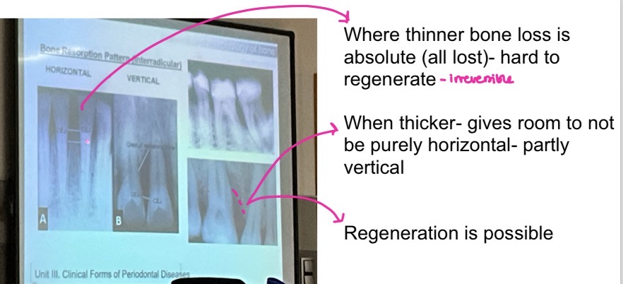 <p>Interdental septum determined type of bone loss</p><p>Horizontal- reduced bone height but bone margin remains perpendicular to tooth surface- perio pocket will be suprabony</p><p>Vertical- thickness of interproximal septum more than 1.5-2.5mm- infrabony </p>