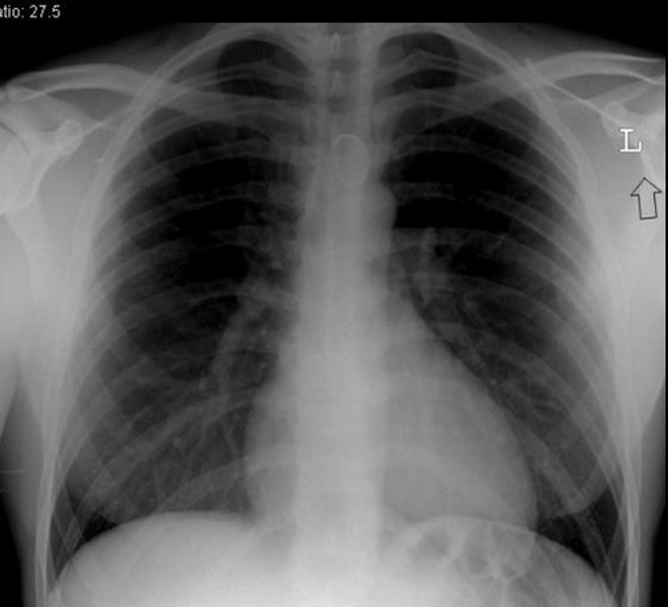 <p>normal x ray. more suggestive of viral aetiology.</p>