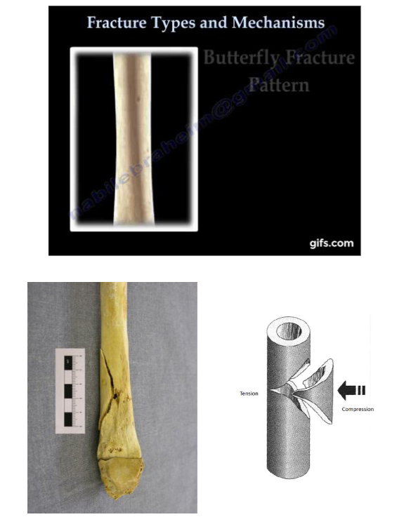 <p>Comminuted Fracture: Butterfly Fracture</p>