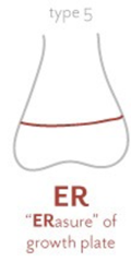 <p>crush to epiphysis at physis</p>