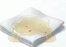 <p>Name this exudate:</p>