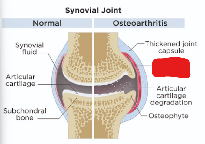 <p>what is it<strong> (Osteoarthritis)</strong></p>