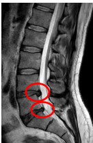 <p>Compression radiculaire postérieure causant des symptômes dans le dermatome correspondant.</p>