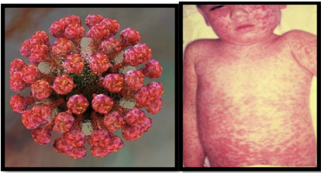 <p><span style="background-color: transparent;">What is congenital rubella syndrome? </span><span style="background-color: transparent; font-family: "Helvetica Neue", sans-serif;"><strong>(CRS):</strong></span></p><p></p>