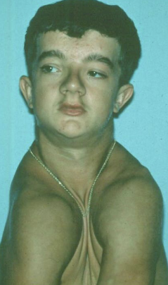 <p>syndrome characterized by dental and clavicle abnormalities, AD inheritance, prolonged retention of deciduous teeth, numerous unerupted permanent and supernumerary teeth </p>