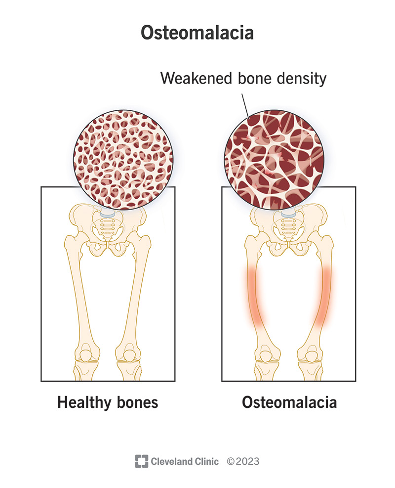 <p><span style="color: rgb(0, 0, 0);">Children → Rickets (“bow legs”)<br>Adults → Osteomalacia</span></p>