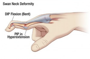 <p><strong>PIP joint area</strong></p><ul><li><p>In people w/ joint hypermobility</p></li><li><p>Can occur after PIP dorsal dislocation</p></li><li><p>Volar plate insufficient @ limiting PIP joint hyperextension</p></li><li><p>Lateral bands sublux dorsally &amp; become ineffective @ extending DIP joint</p></li><li><p>DIPJ flexion, PIPJ extension </p></li></ul><p></p>
