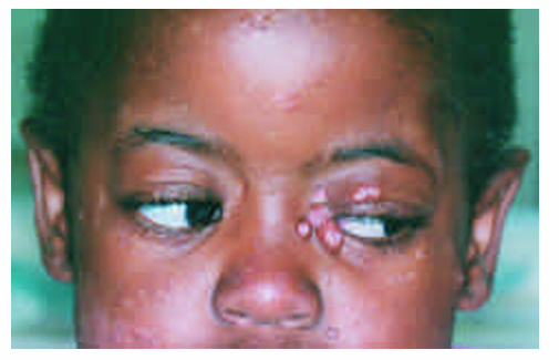 <p>1.what is this lesion?</p><p>2. how to treat/ manage it?</p><p>3. classification of oral lesion in HIV?</p>