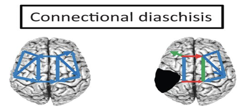 <p>Connectional diaschisis</p>