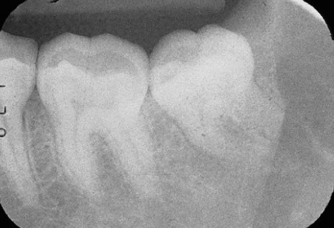 <p>Foreshortening</p>