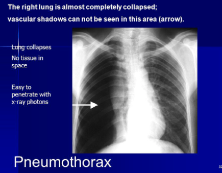 <p>collapsed lung </p>