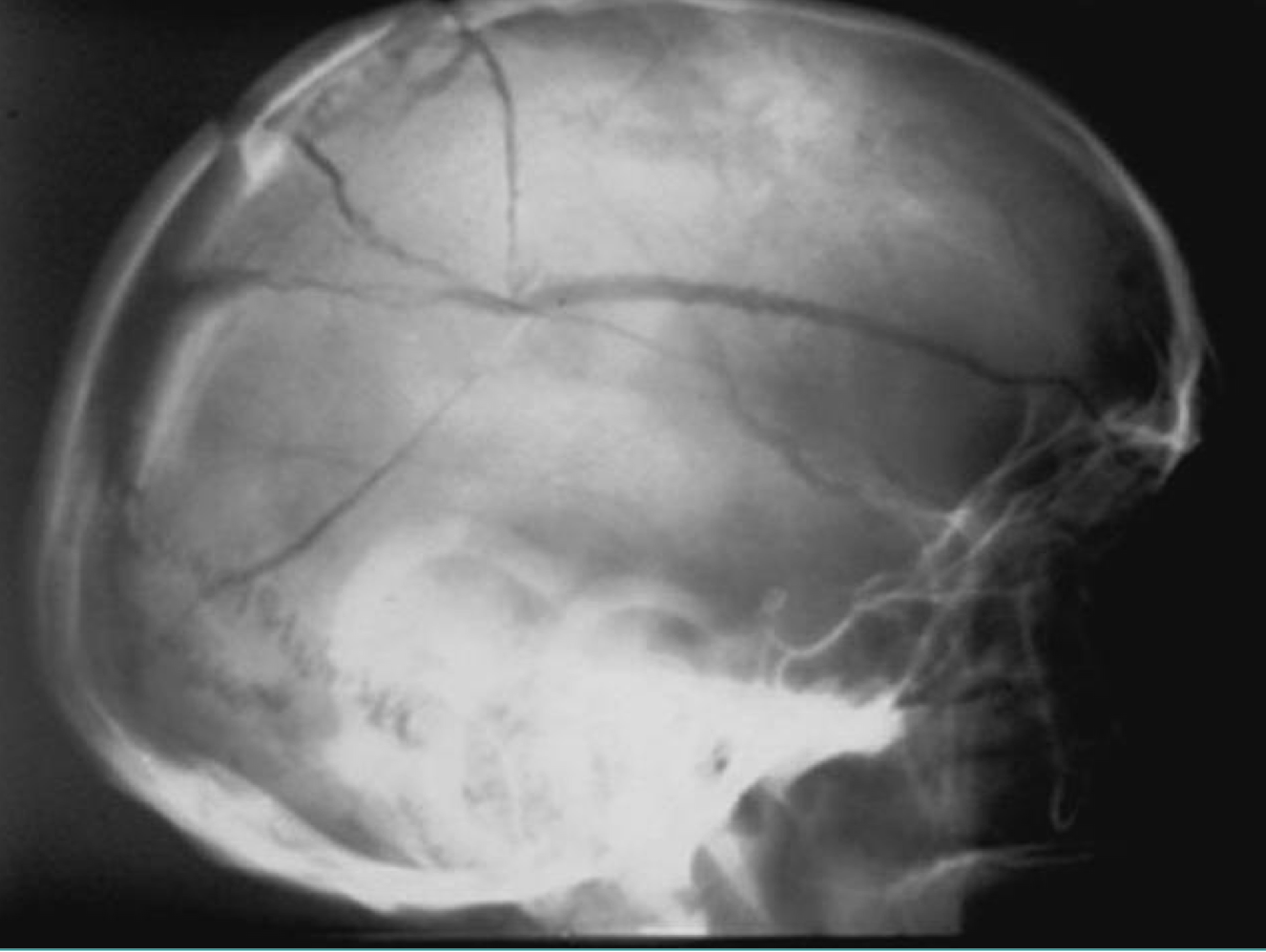 <p>What is the most common skull fracture</p>