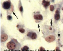 <p>pink eosinophilic cytoplasmic inclusion bodies (arrows) and cell swelling</p>