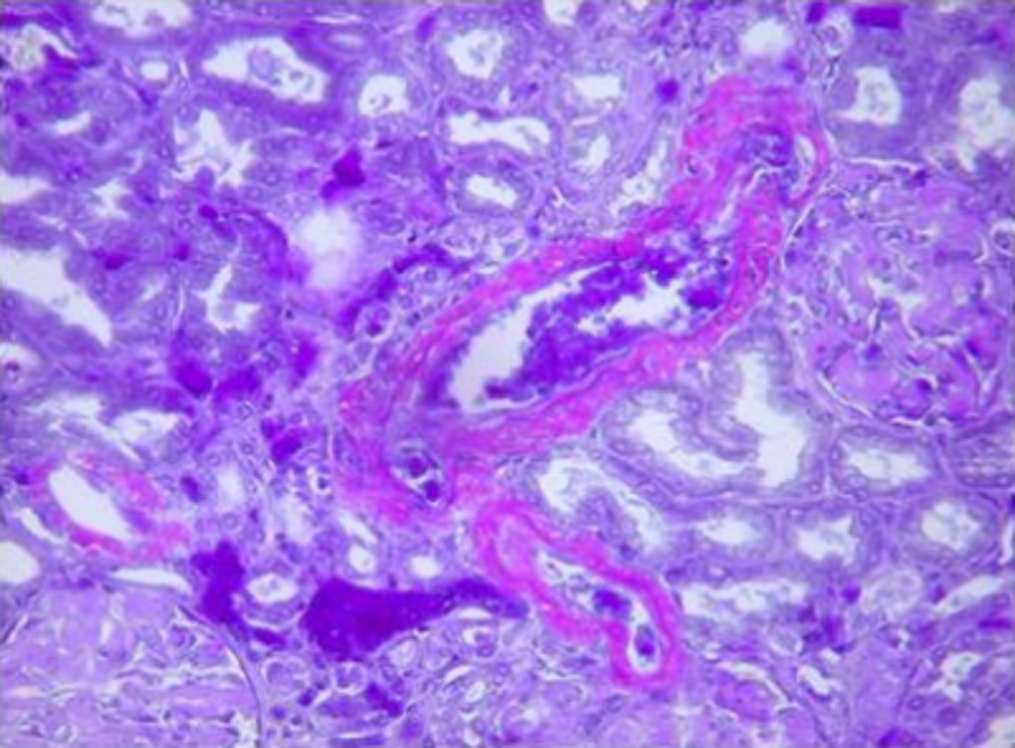 <p>amyloid</p><p>Feedback:</p><p>Amyloid is deposited in the blood vessel walls and stained purplish-violet by the crystal violet procedure. Some deposits can also be seen in the glomerulus of this kidney.</p>