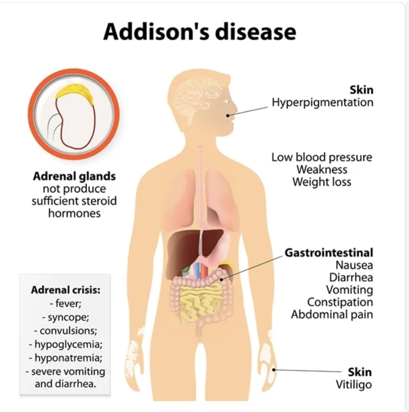 <p><span>Endocrine disorder in which the adrenal glands do not produce enough hormones: weakness, weight loss, low blood pressure</span></p>