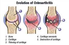 <p>osteoarthritis</p>
