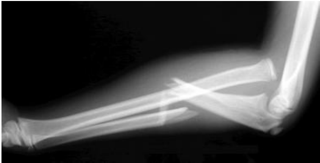 <p>Fracture of proximal ulna + disclocation of radial head</p>