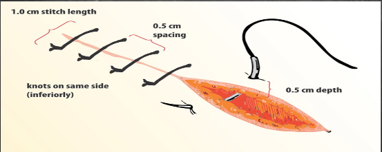 <ul><li><p>each is tied and cut individually</p></li><li><p>advantages = secure, good tension control, less likely to fail as a whole</p></li><li><p>disadvantages = time consuming, more foreign material</p></li><li><p>Simple interrupted = Standard and Most used; good for basic closure</p></li><li><p>horizontal mattress = provides tension release. Often used in flap edges</p></li><li><p>vertical mattress = ensures deep and superficial tissue approximation. For thicker issues</p></li></ul><p></p>