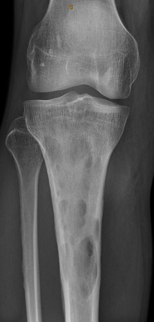 <p>Inflammation of the bone caused by bacterial infection - often seen in diabetic patients</p><p></p><p>Radiographic appearance </p><ul><li><p>Lower bone density</p></li><li><p>Lytic lesions - dark areas of bone with ‘moth-bitten appearance’</p></li></ul><p></p>