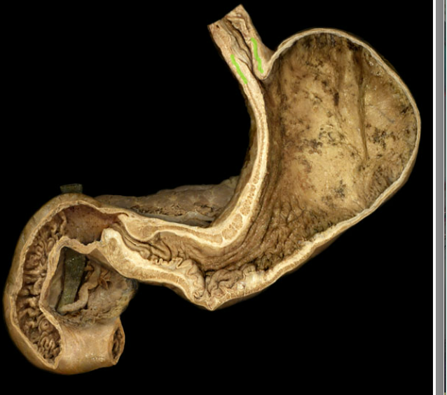 <p><span>Lower esophageal sphincter</span></p>