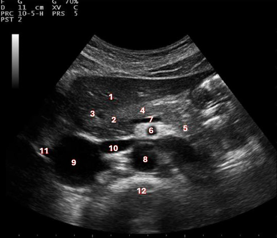 <p>What structure/vessel is indicated by #5?</p><p>a. tail of pancreas</p><p>b. head of pancreas</p><p>c. left lobe of liver</p><p>d. body of pancreas</p>