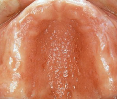 <ol><li><p>Residual ridge resorption</p></li><li><p>Ill-fitting denture causes tissue problems (conventional)</p></li><li><p>More cost effective than making a whole new denture</p></li></ol><p></p>