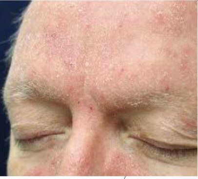 <p>Actinic Keratosis (<em>precursor to SCC)</em>: superficial keratotic papules</p><ul><li><p>“come and go” on sun damaged skin</p></li><li><p>easier to feel than see</p></li></ul><p>MIMIC: superficial xerosis/ seborrheic dermatitis</p><ul><li><p>scale is less keratotic (more dry)</p></li><li><p>improves w/ moisturizers or mild topical steroids</p></li></ul><p></p>