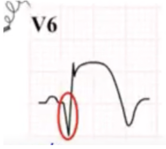 <p>In this picture of an ECG of a myocardial infarction, what does the red circle represent?</p>