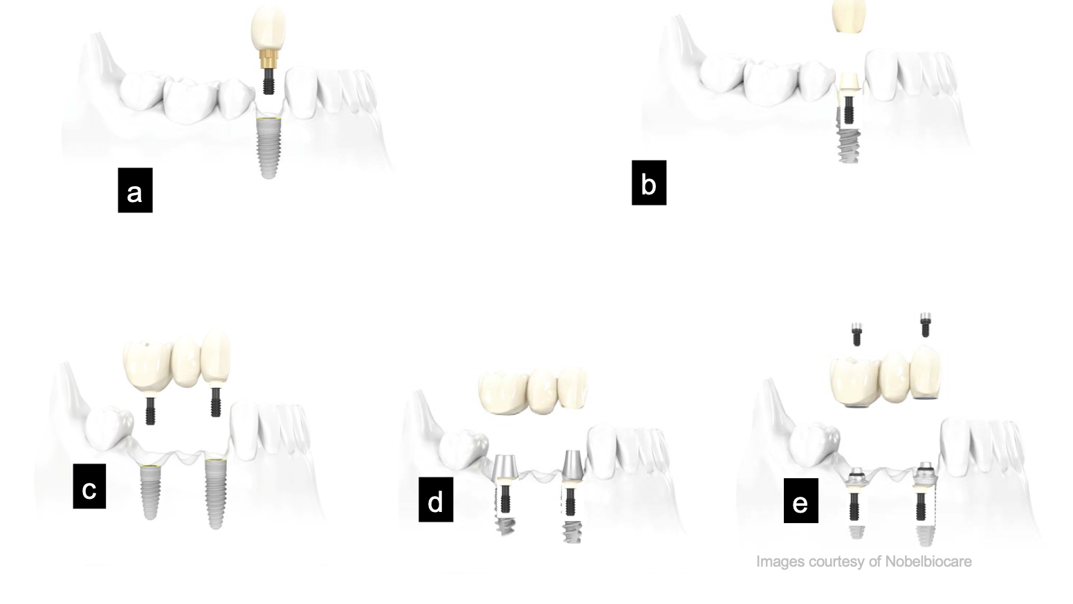 <p>single vs multiple unit, implant or abutment supported, cement vs screw retained</p>