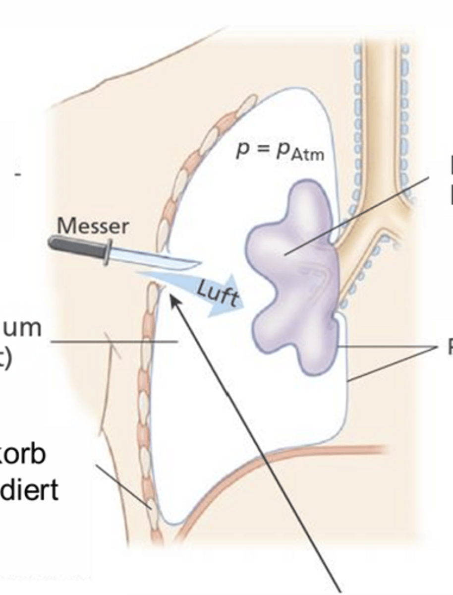 <p>Lebensbedrohliche Erkrankung bei der die Luft, durch ein Loch in Pleuraspalt eindringt & sich zwischen Lunge & Brustkorb ansammelt -> dringt in Pleurahöhle ein</p><p>-> Führt zu Lungenkollaps</p>